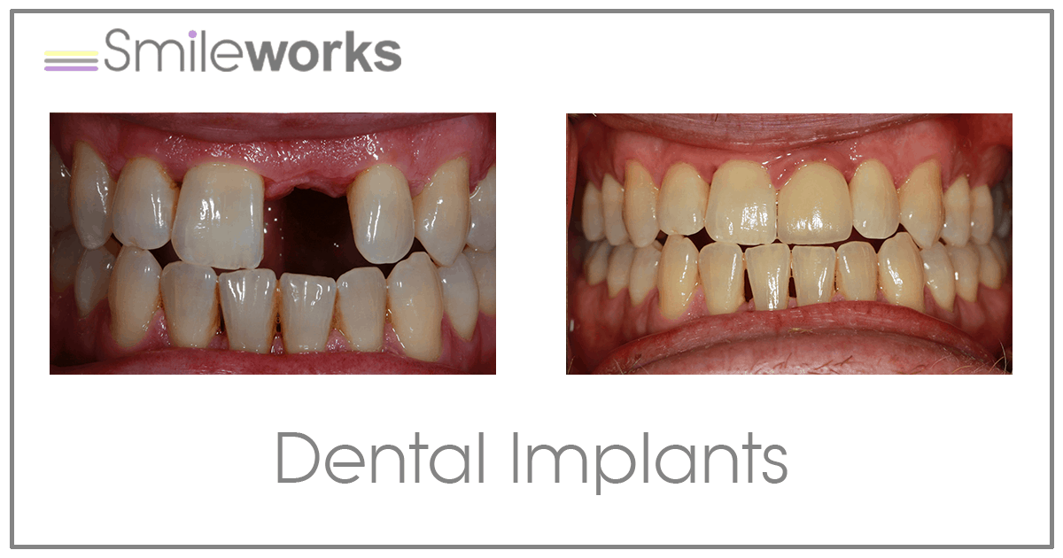 Dental Implants Liverpool *£94/m* A Better Smile Means a Better Life
