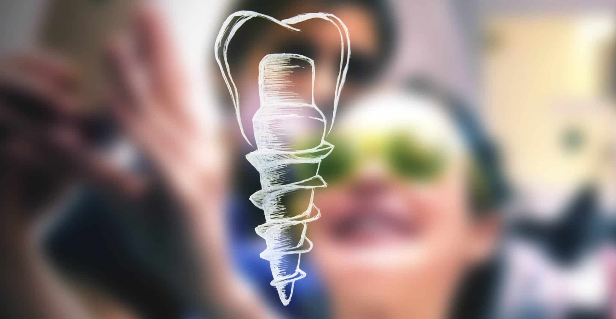 Dental Implants Liverpool Affordable & Quick Treatment at Smileworks