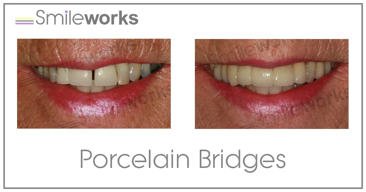 Existing Smileworks porcelain bridge case: before on the left and after on the right.