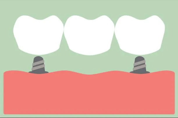 Illustration of a bridge supported by two dental implants.