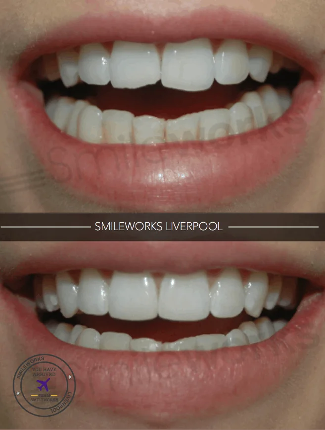 Existing Smileworks before-and-after composite restoration photographs.