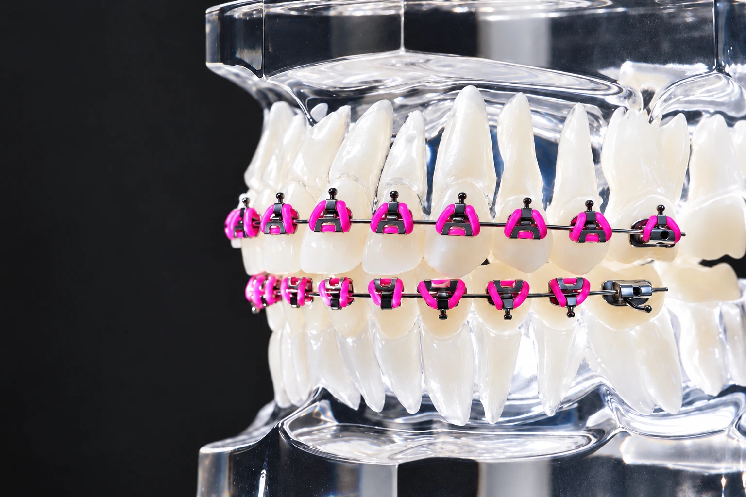 Fastbraces appliance Fastbraces demonstration model with matching pink triangular brackets on the upper and lower teeth