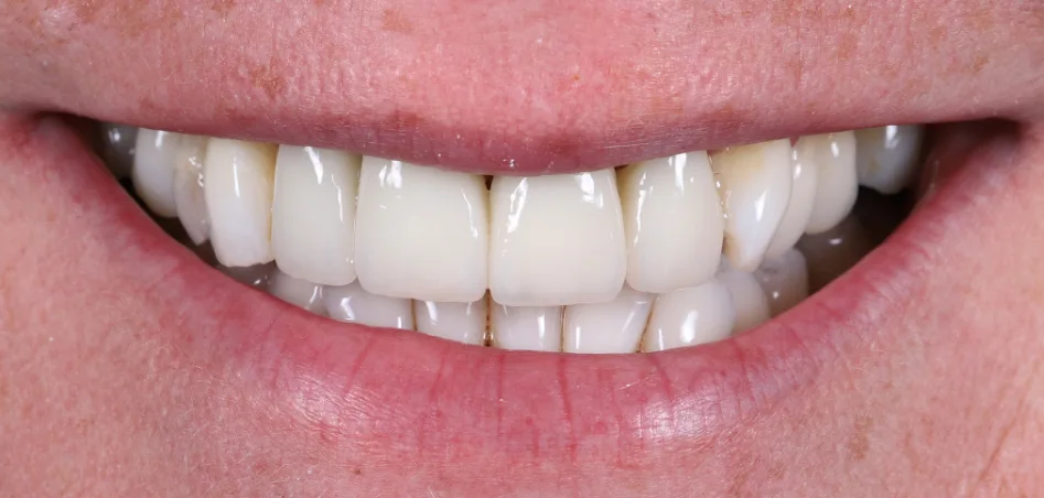 After treatment
