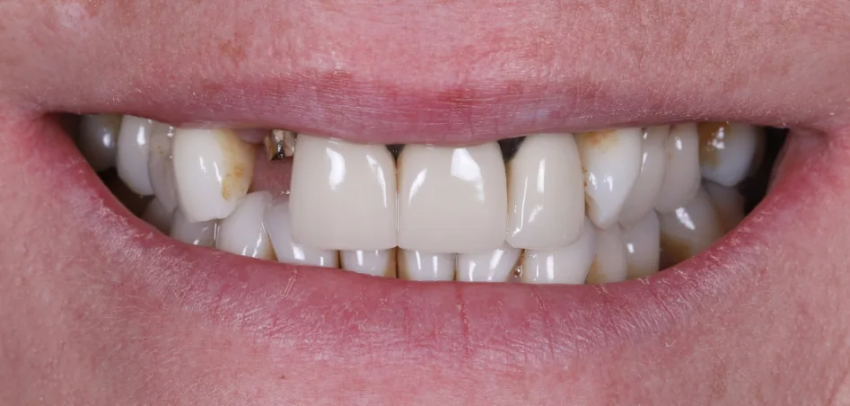 Before treatment