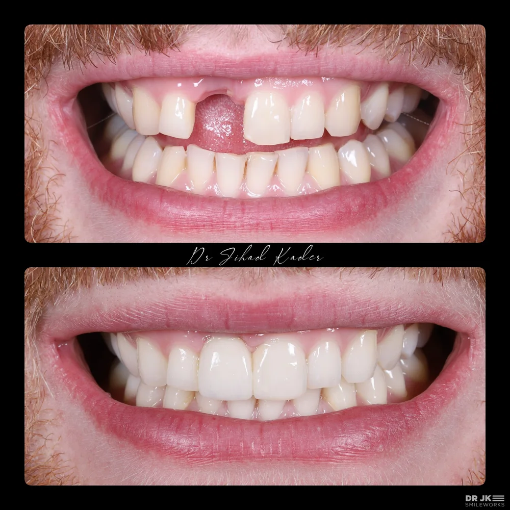 Existing implant treatment case