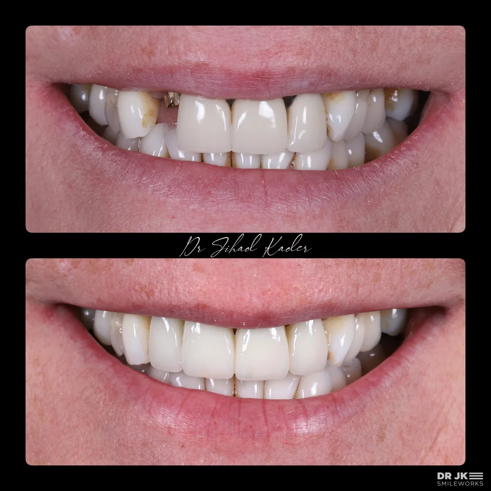 Existing smile treatment case