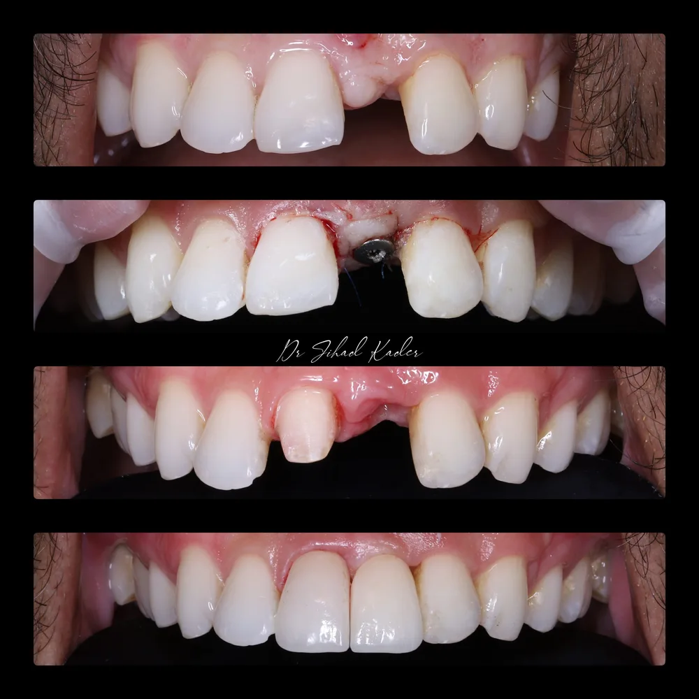 Existing implant and gum tissue treatment case