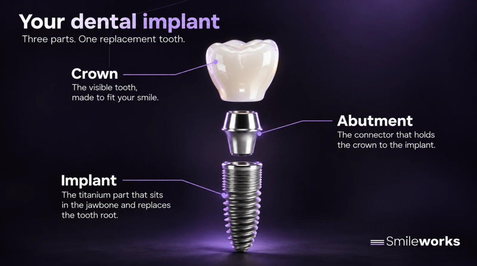 Illustration of a dental implant, abutment and crown