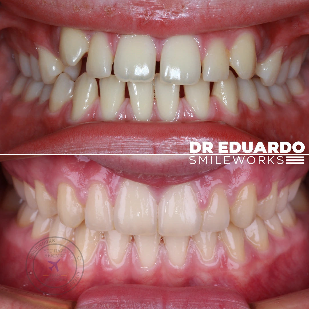 Existing Smileworks orthodontic before and after photographs