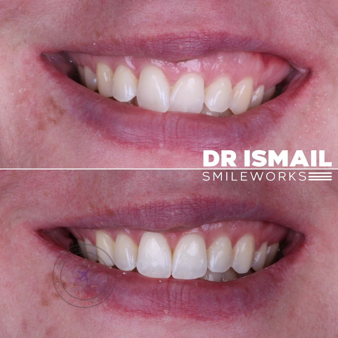 Existing Smileworks orthodontic before and after photographs