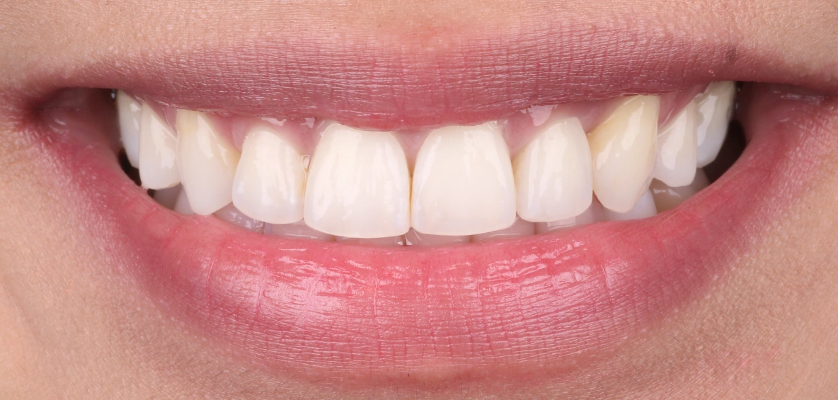 After Spark clear aligner treatment at Smileworks