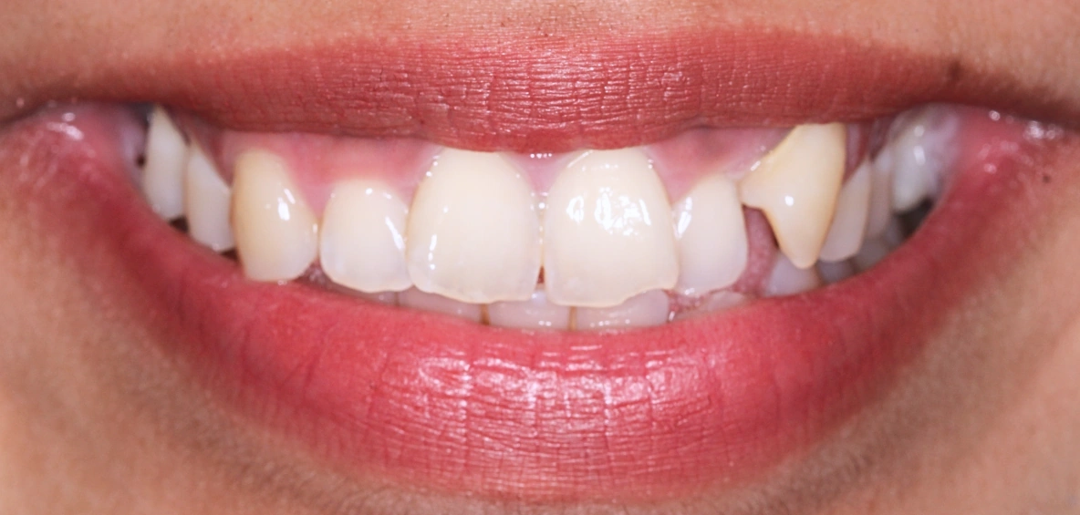 Before Spark clear aligner treatment at Smileworks