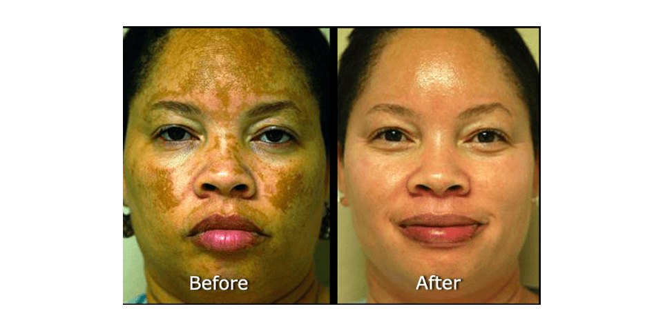 Obagi sales blue peel