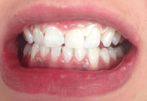 Burned gums from illegal whitening