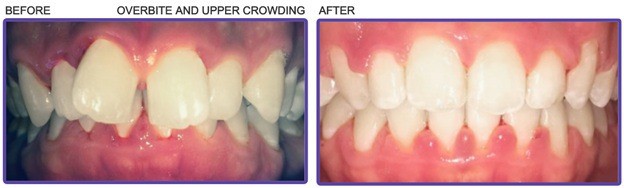 teeth overbite crowding before and after