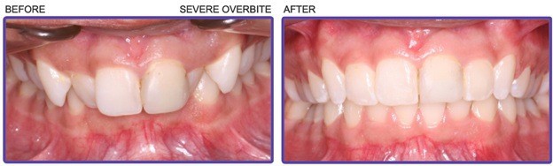 teeth severe overbite before and after