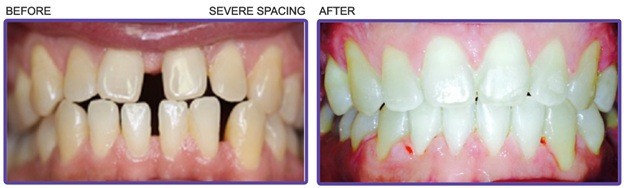 teeth severe spacing before and after