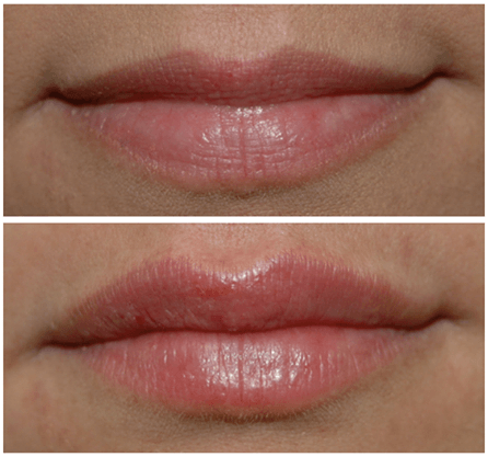 Lip fillers before and after