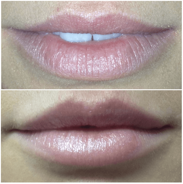 Lip Fillers Liverpool Breathtaking Precision And 2023 Prices