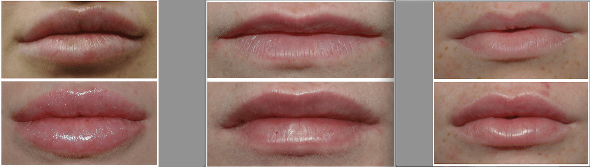 best lips in Liverpool before and after