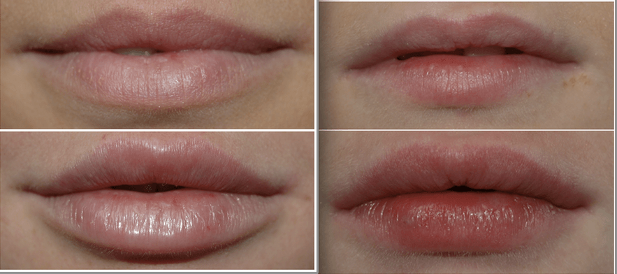 lip fillers before and after