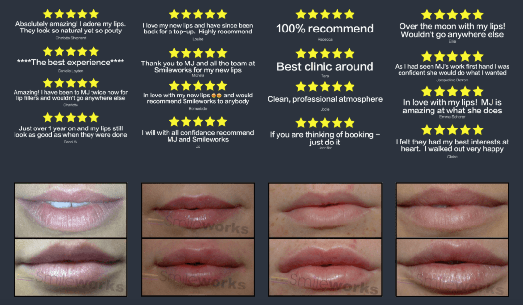 Lip fillers 5 star reviews