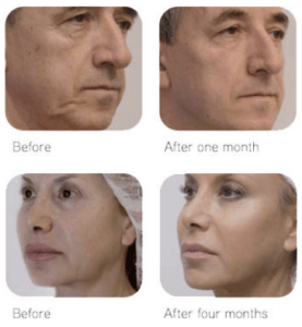 Before and after pictures of Silhouette soft