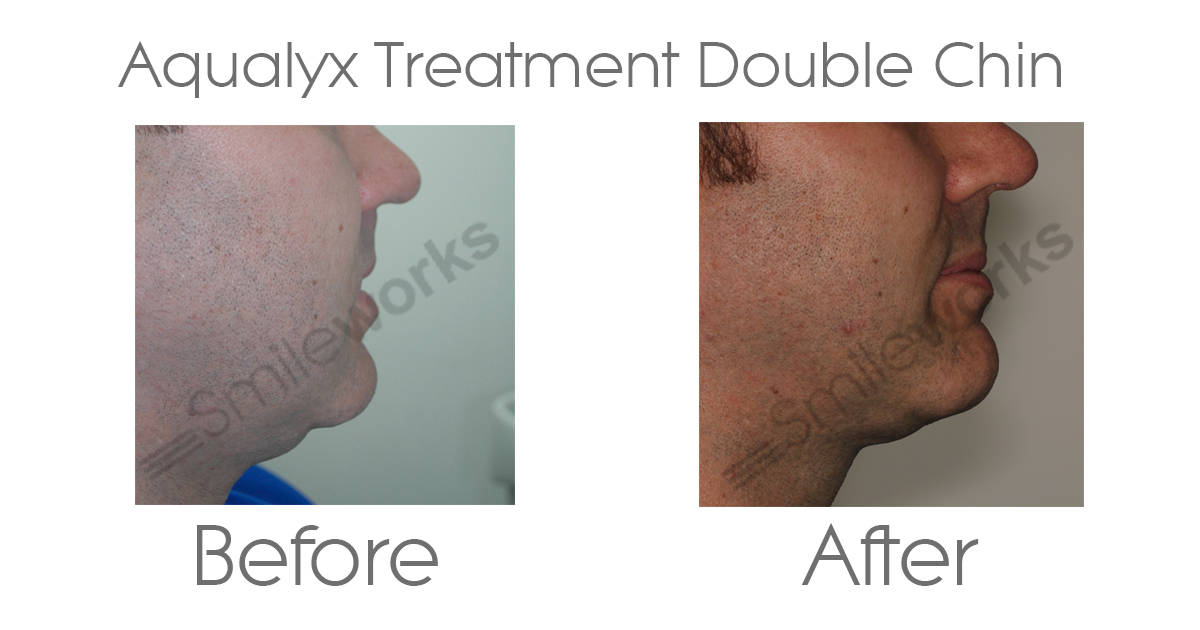 Aqualyx Chin treatment