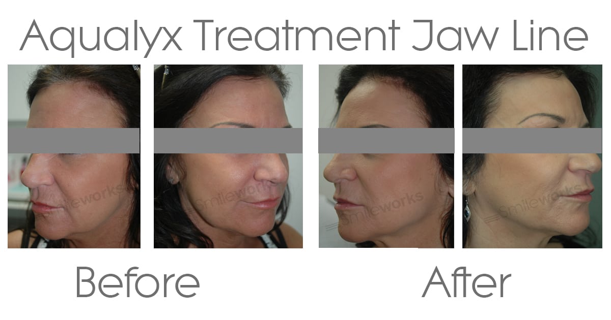 Aqualyx before and after