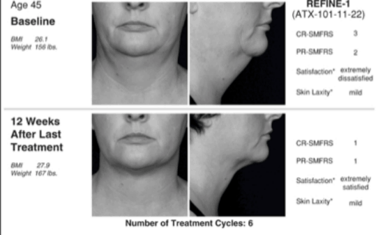 Clinical trial SMFRS of aqualyx treatment