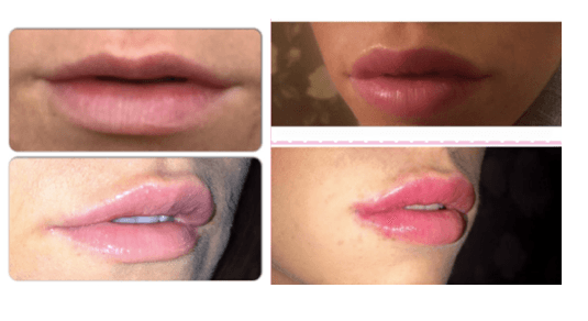 Bad Lip jobs 