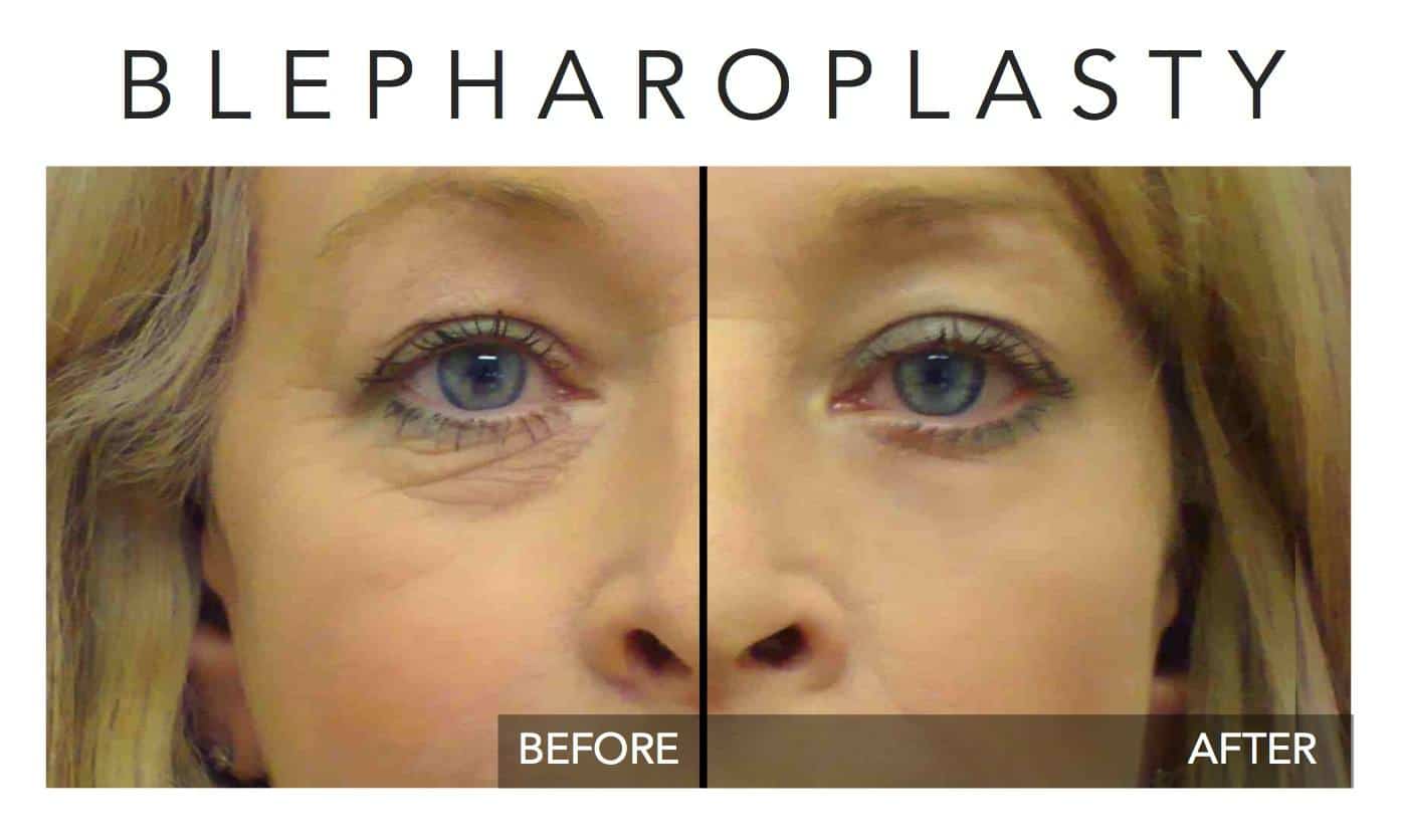 Eye-lift with Plexr