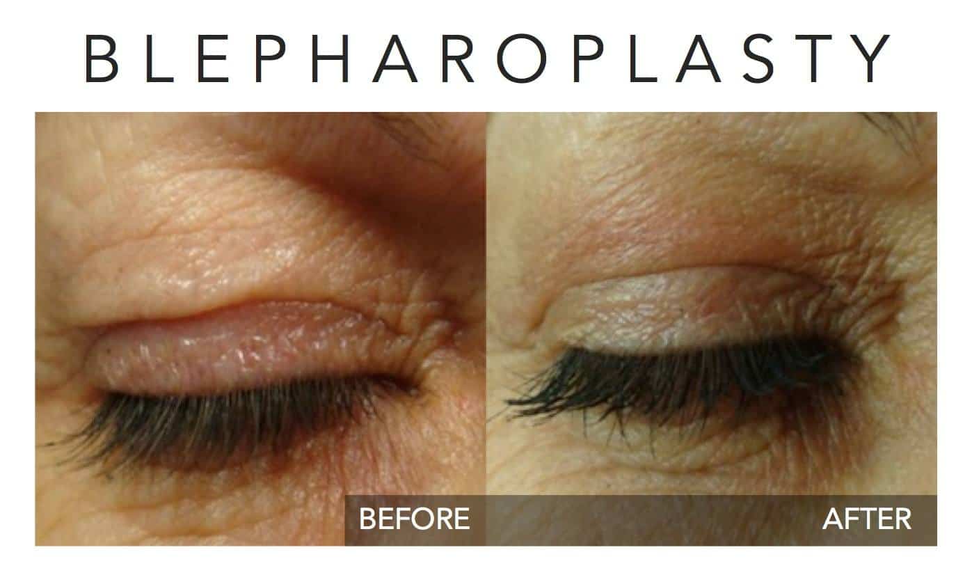 Eye-lift with Plexr