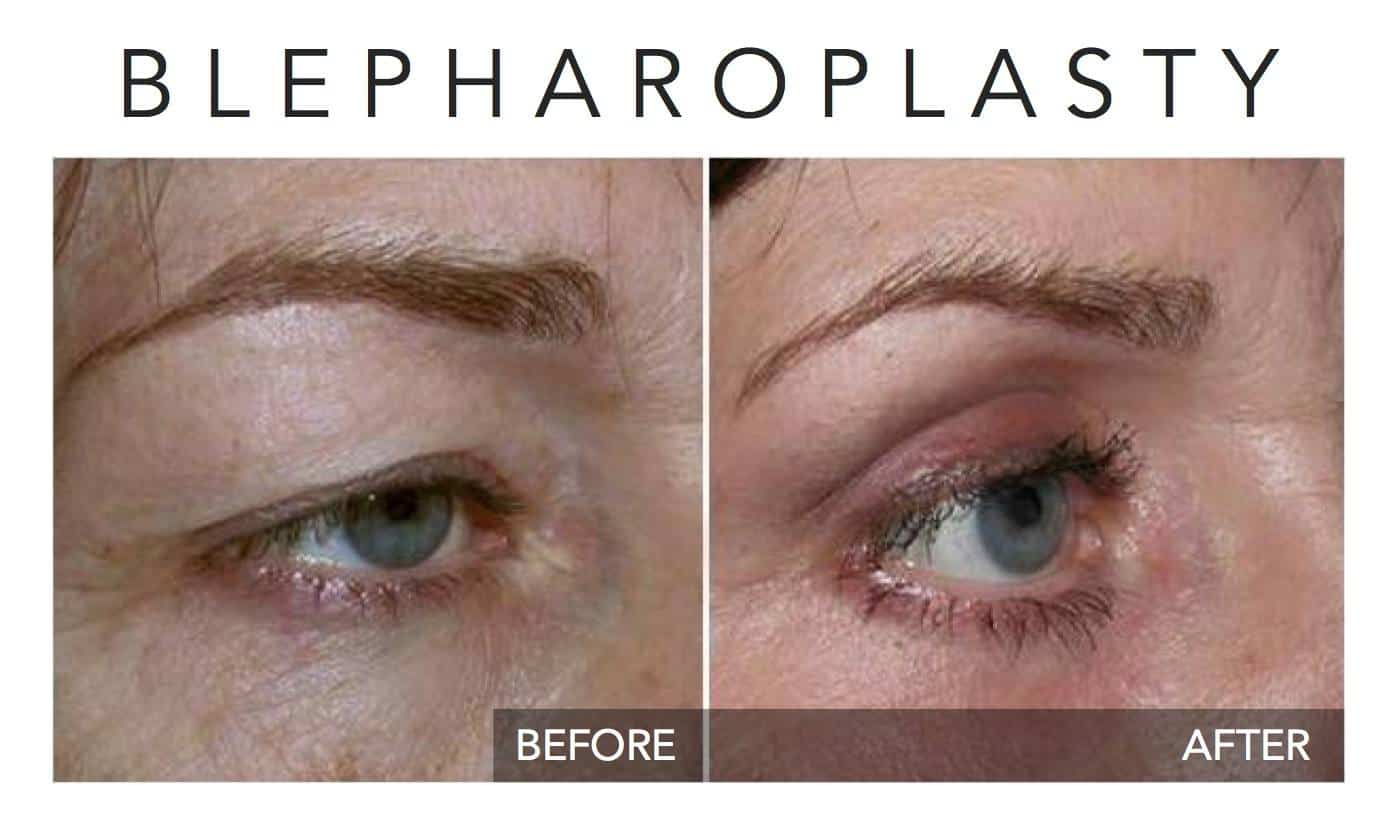 Eye lifts with Plexr