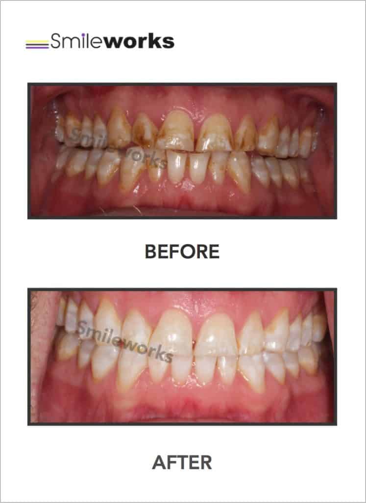 Patchy teeth after zoom whitening bswera
