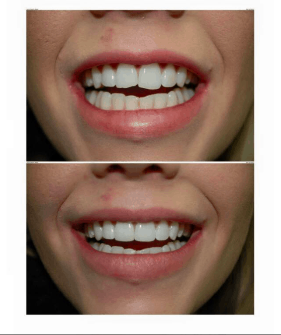 How much is enlighten teeth whitening