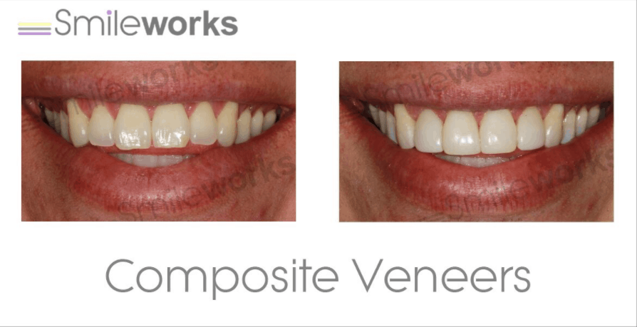 composite veneers