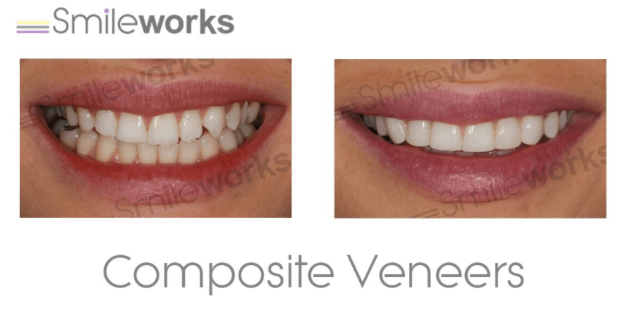 composite veneers