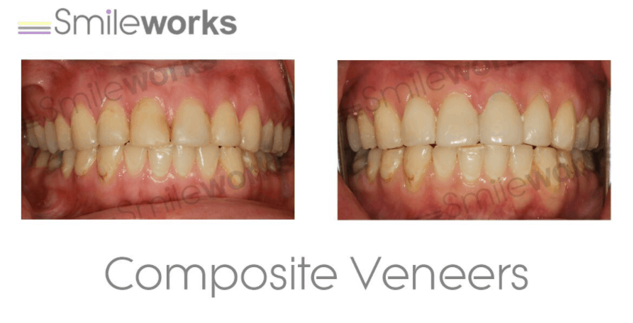 composite veneers