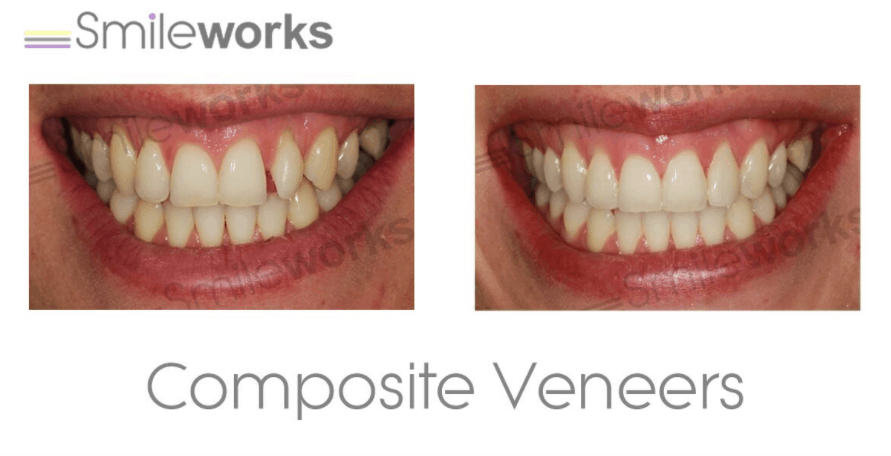 Composite veneers