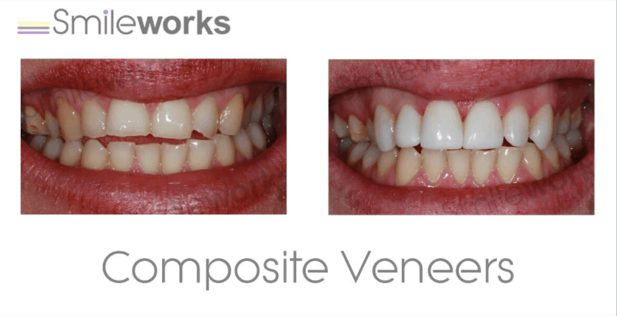 How Much Does Laser Teeth Whitening Cost - TeethWalls