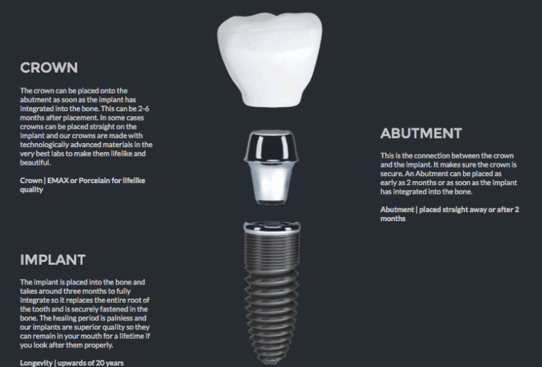 Dental Implants Liverpool £94/m cost Replace missing teeth in 2020
