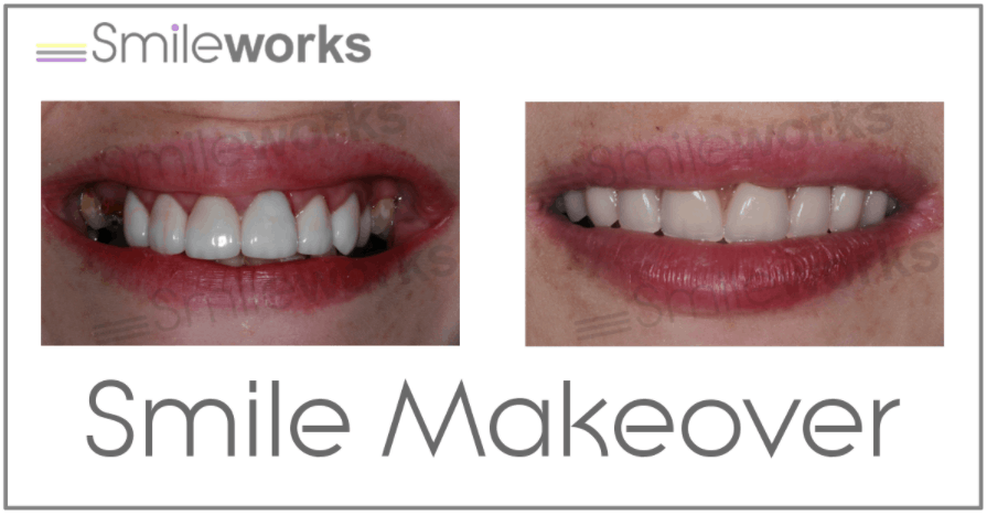 Smile makeover with implants before and after