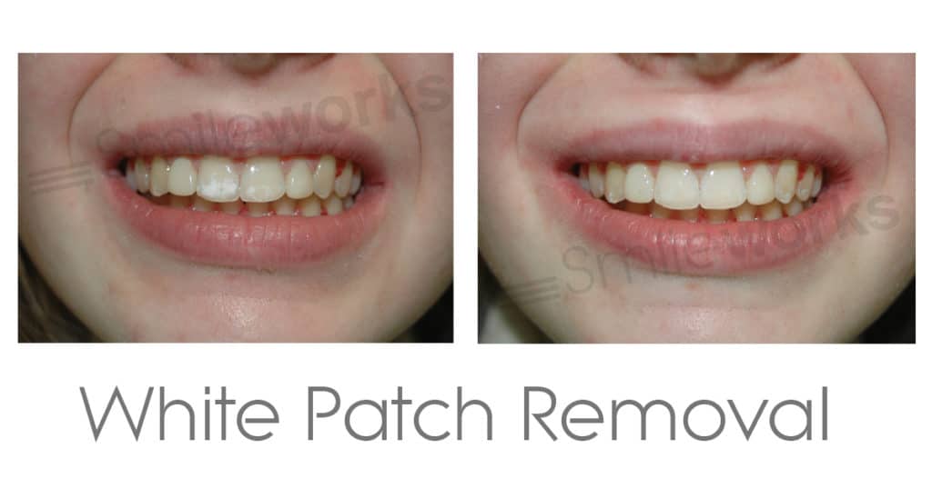Teeth Whitening Liverpool Beautiful, Bright and Responsible