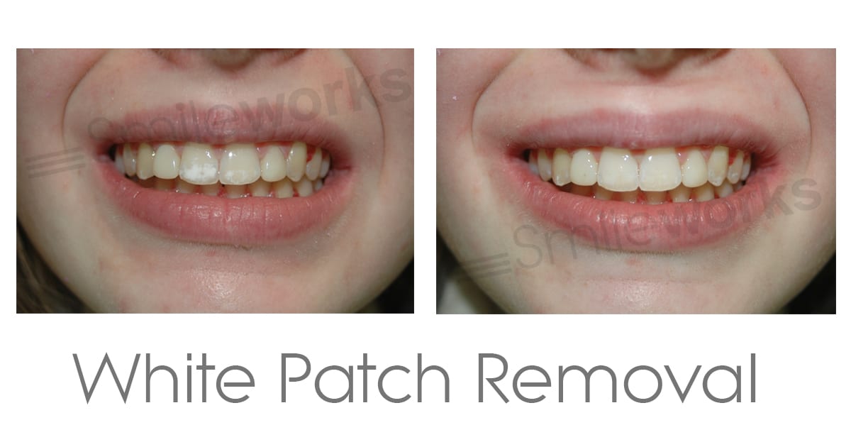 White Patches on teeth before and after