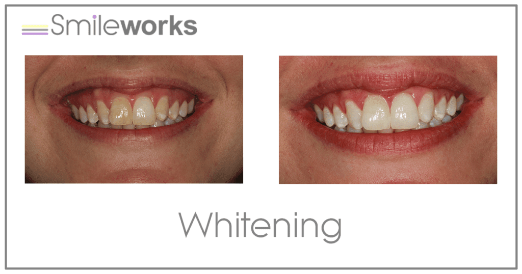 Teeth Whitening Liverpool Beautiful, Bright and Responsible