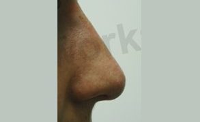 Nose Fillers After