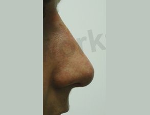 Nose Fillers After