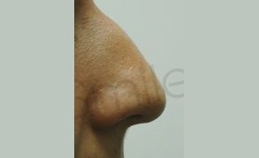 Non Surgical Rhinoplasty Before