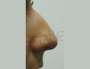 Non Surgical Rhinoplasty Before